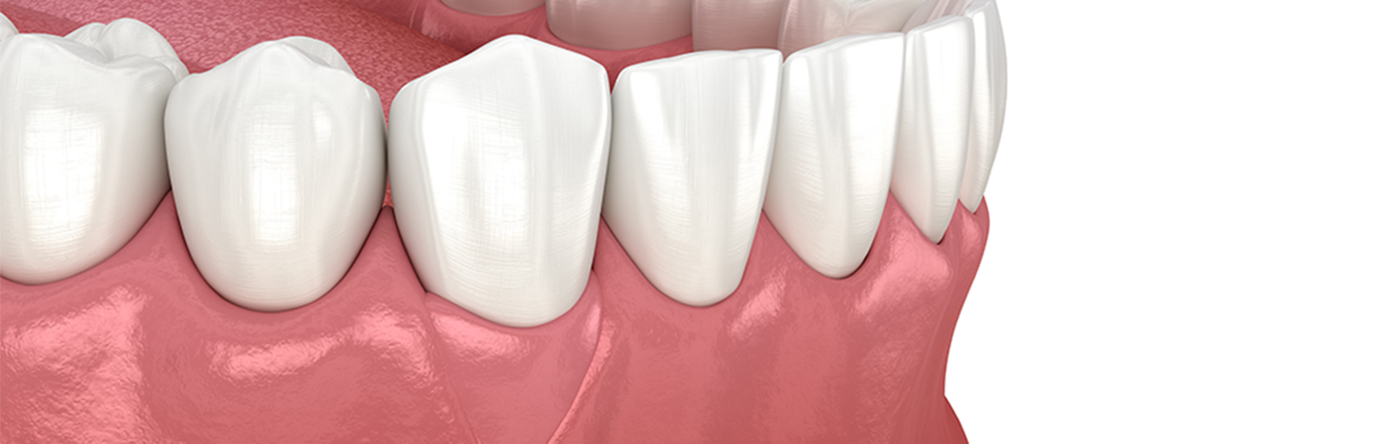重度な歯周病にも対応できる歯周組織再生療法の実施