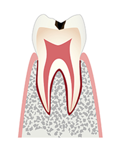 C1（シーワン）：エナメル質の虫歯
