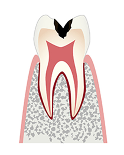 C2（シーツー）：象牙質の虫歯
