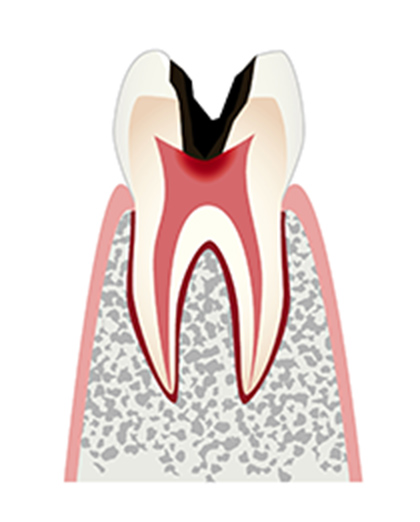 C3（シースリー）：歯髄の虫歯