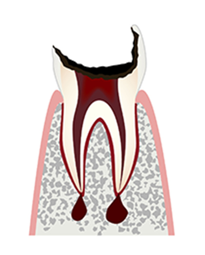 C4（シーフォー）：歯髄が壊死した虫歯