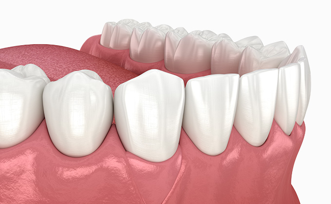 重度の歯周病にも対応できる歯周組織再生療法の実施