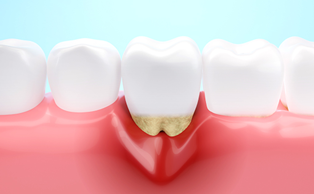 歯周病治療の場合