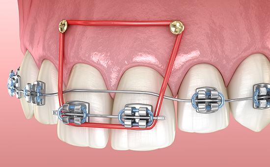 治療期間を短縮できる歯科矯正用アンカースクリュー（TAD）を用いた治療
