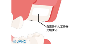サイナスリフト