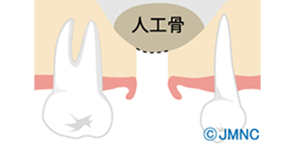 ソケットリフト