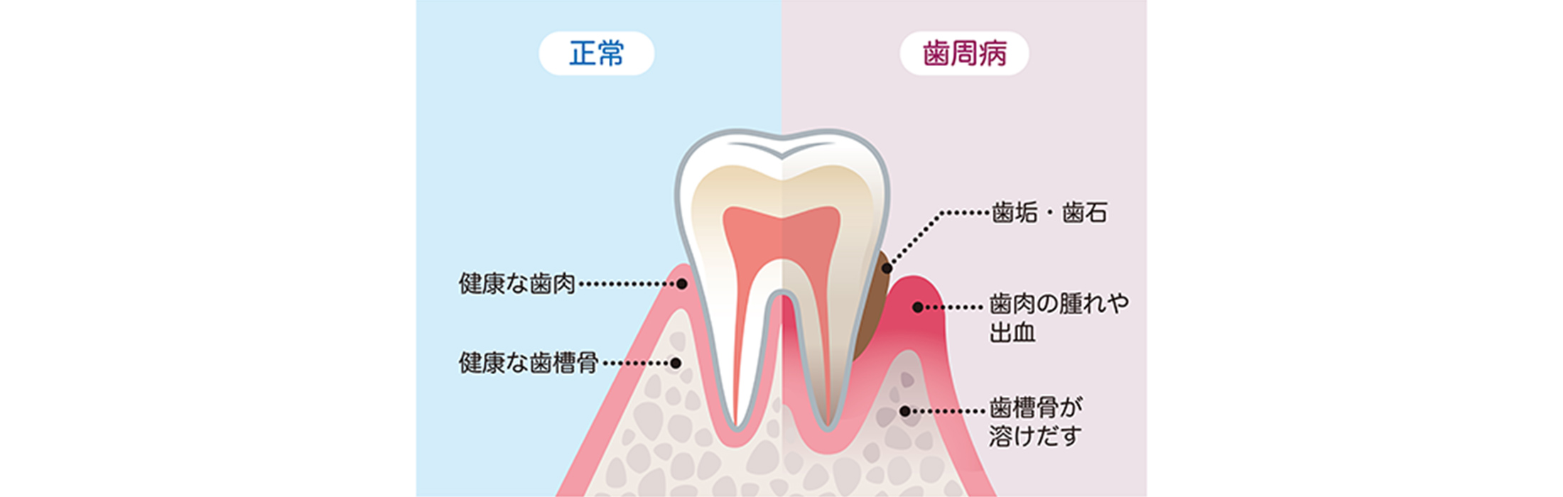 歯周病とは